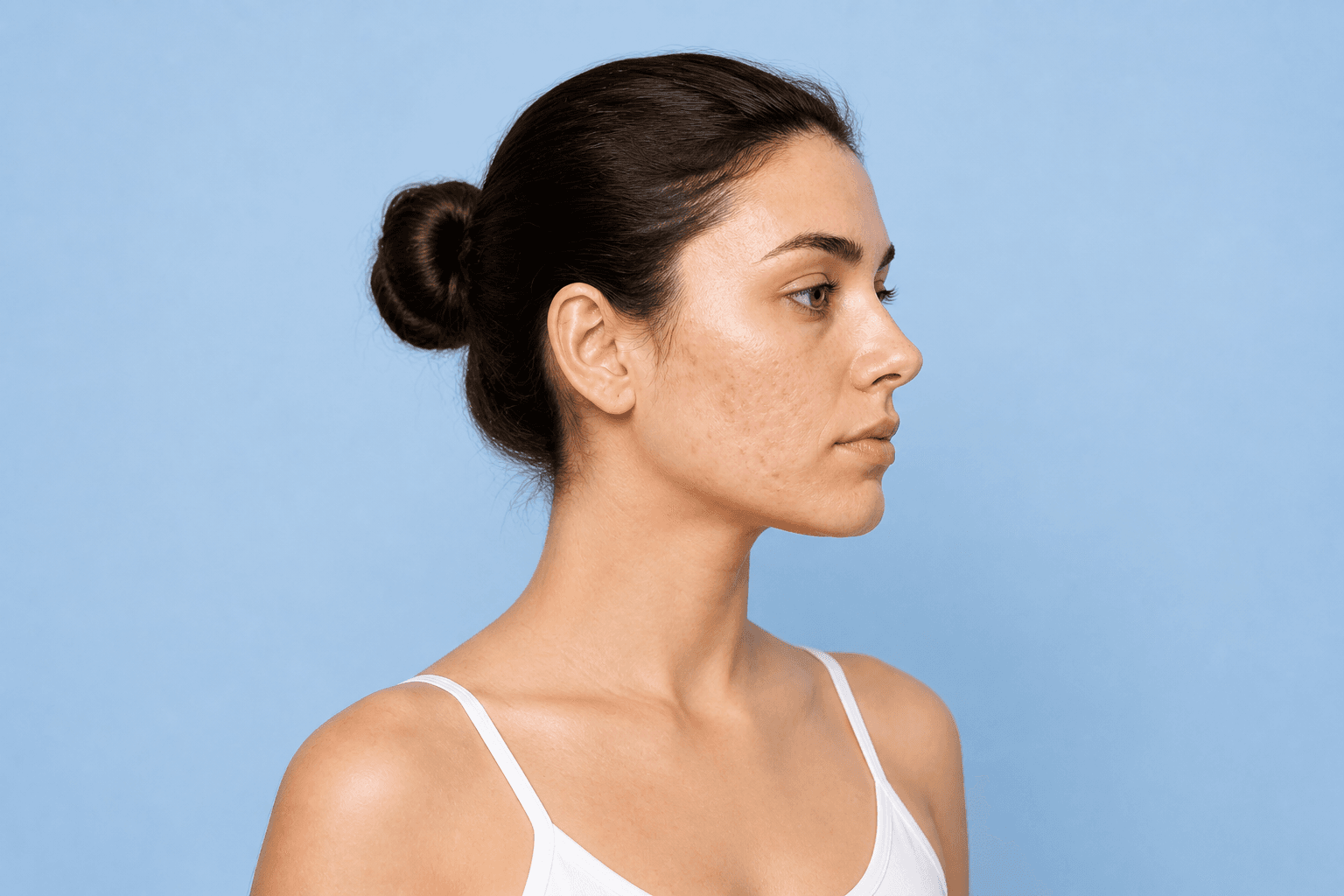 Acne Scar Treatment